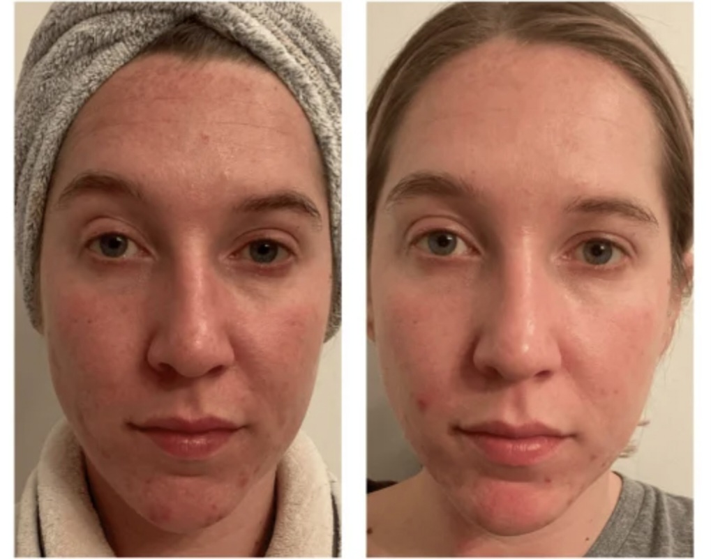 Ana Martinez - antes y después